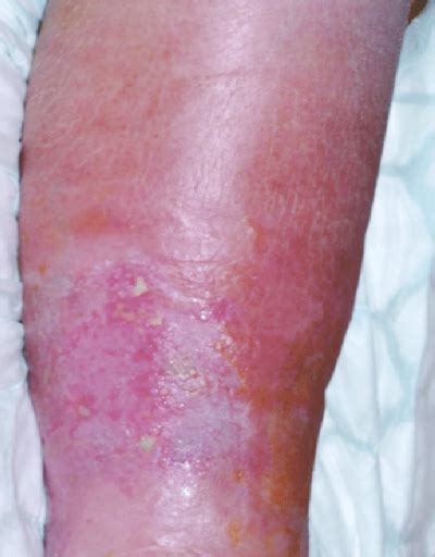 clear fluid leaking from leg|Lymphedema